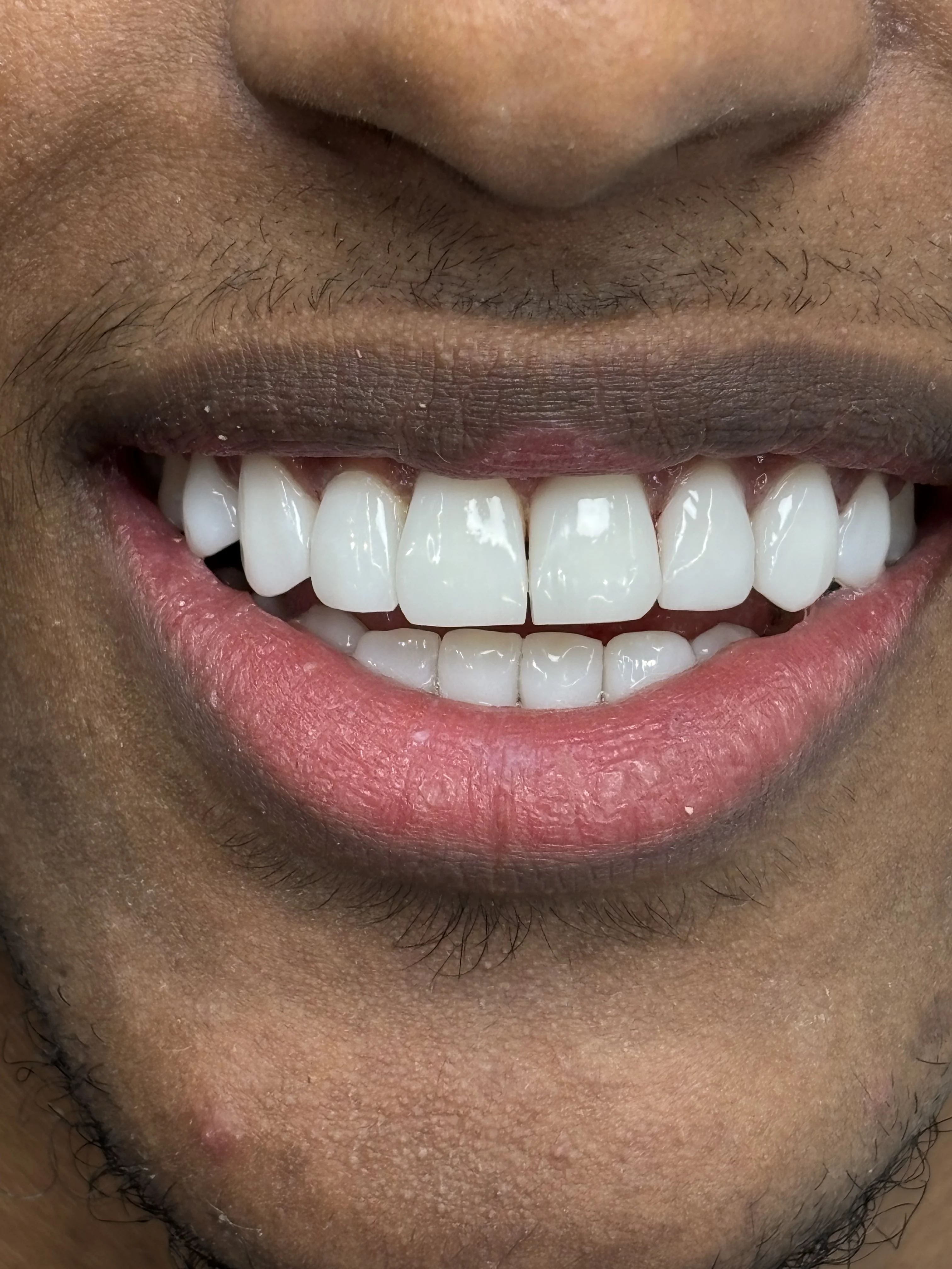 After: beautiful, natural-looking smile