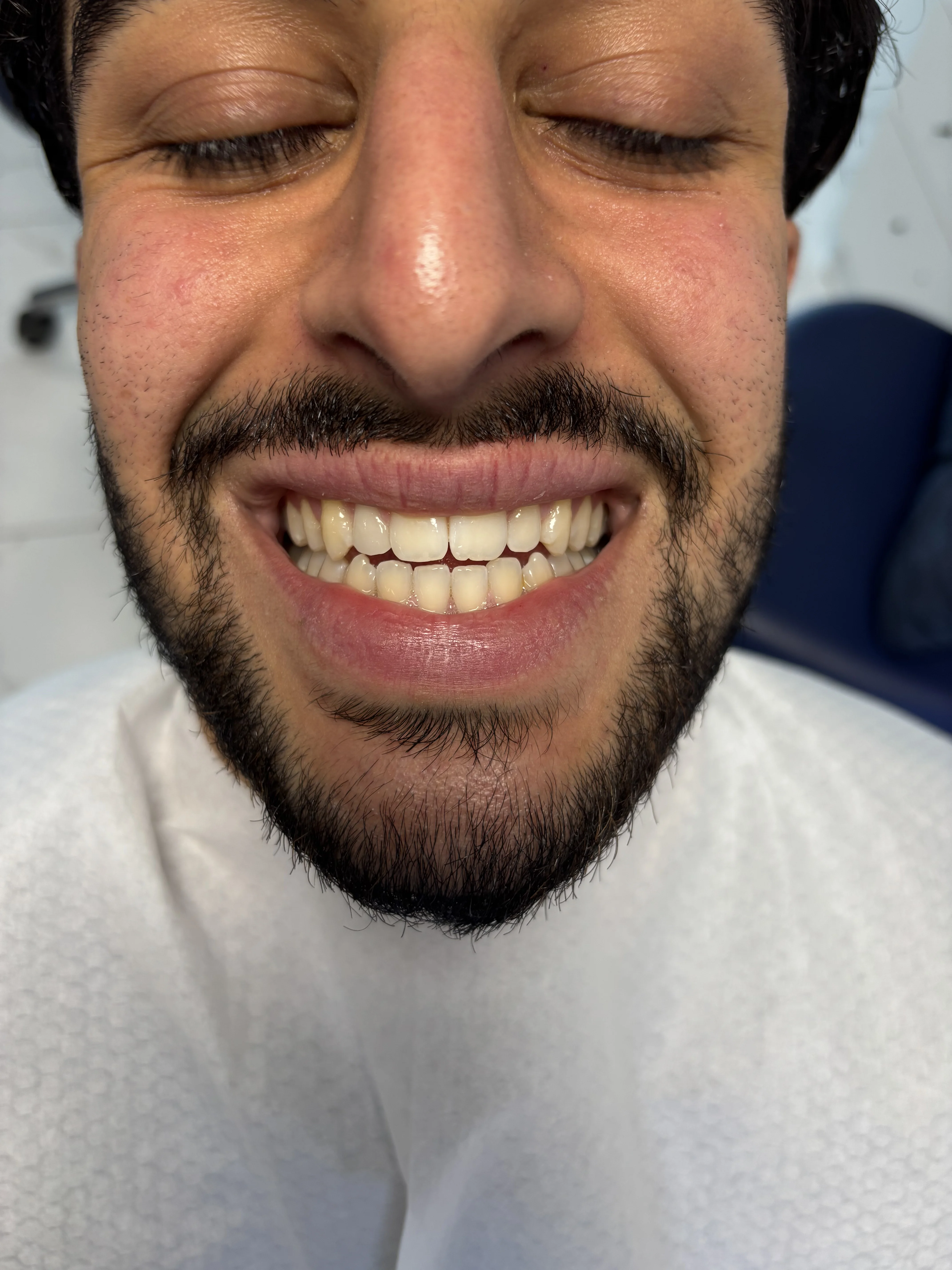 Before: extensive bone and tooth loss