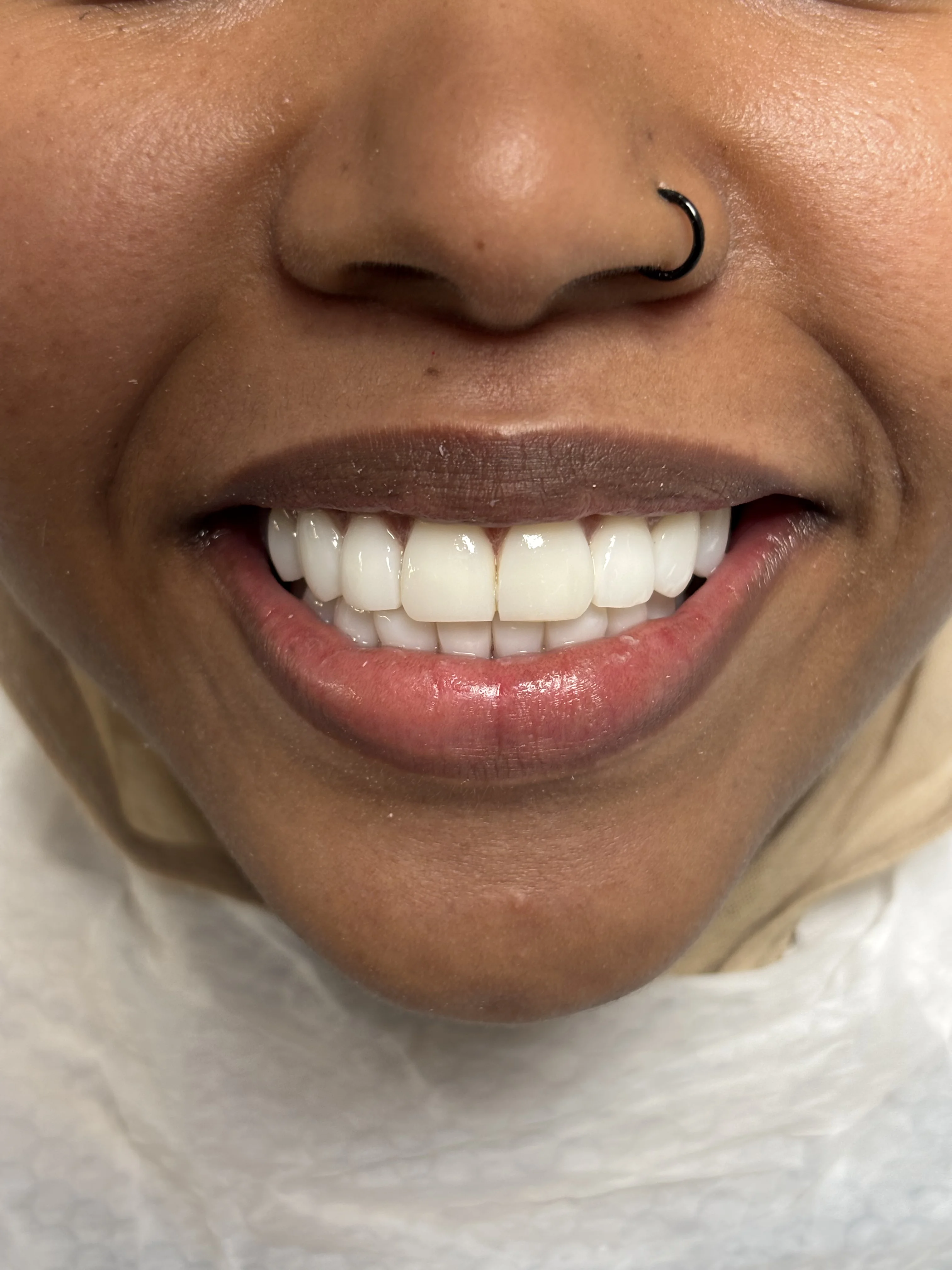 After: fixed restoration using zygomatic implants