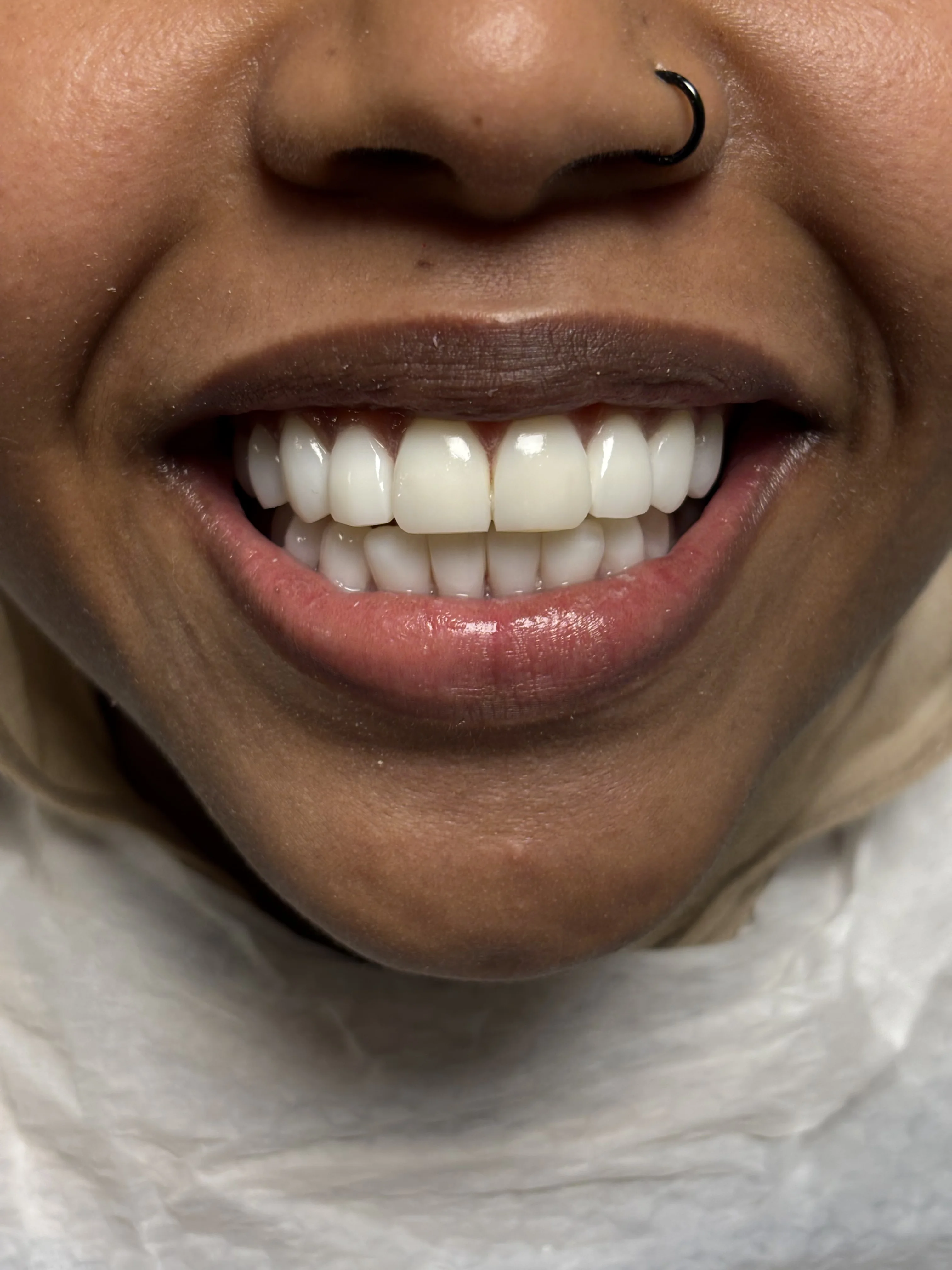 Before: extreme bone loss, limited implant sites
