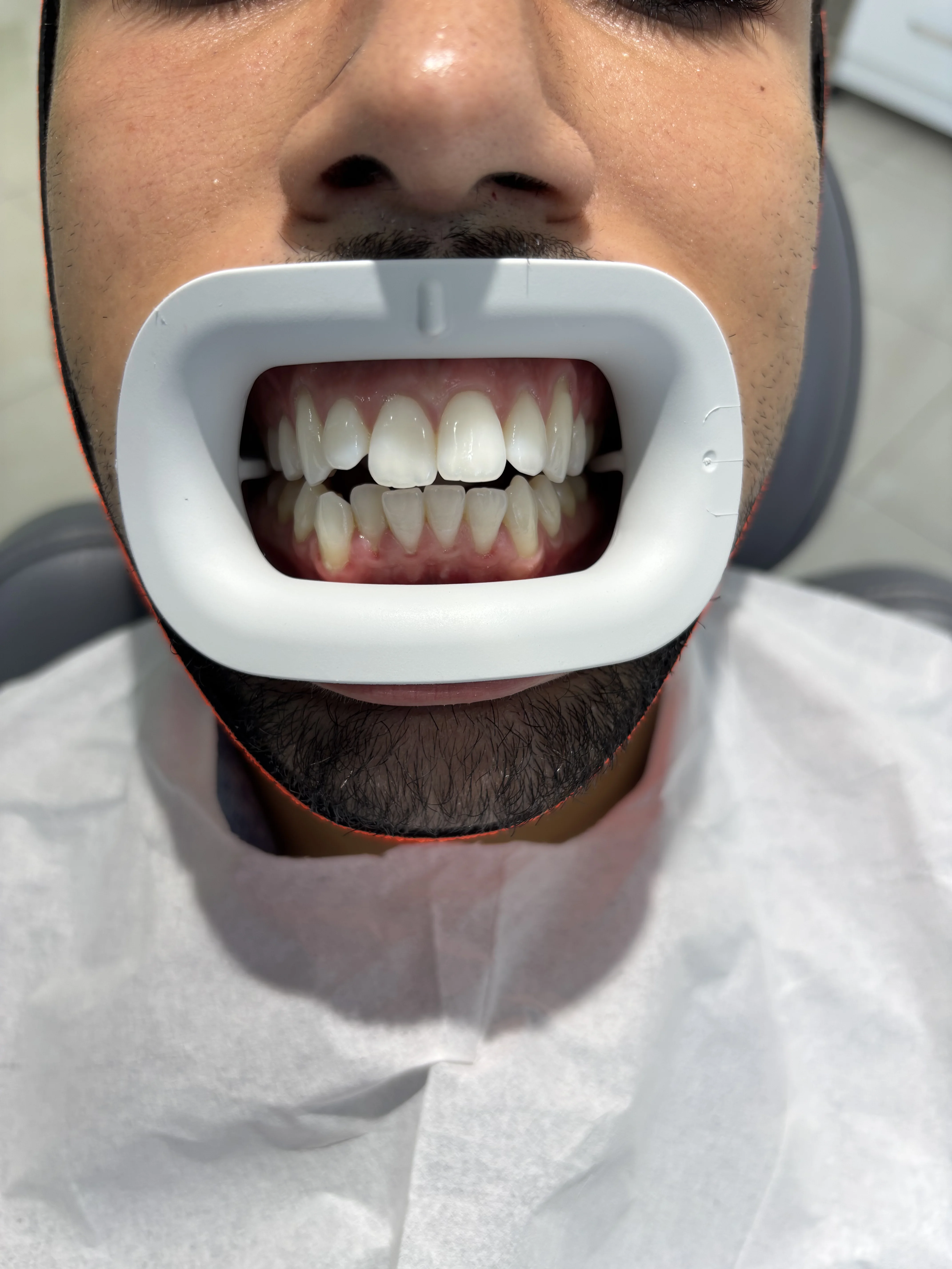 After: zygomatic solution enabling fixed bridge