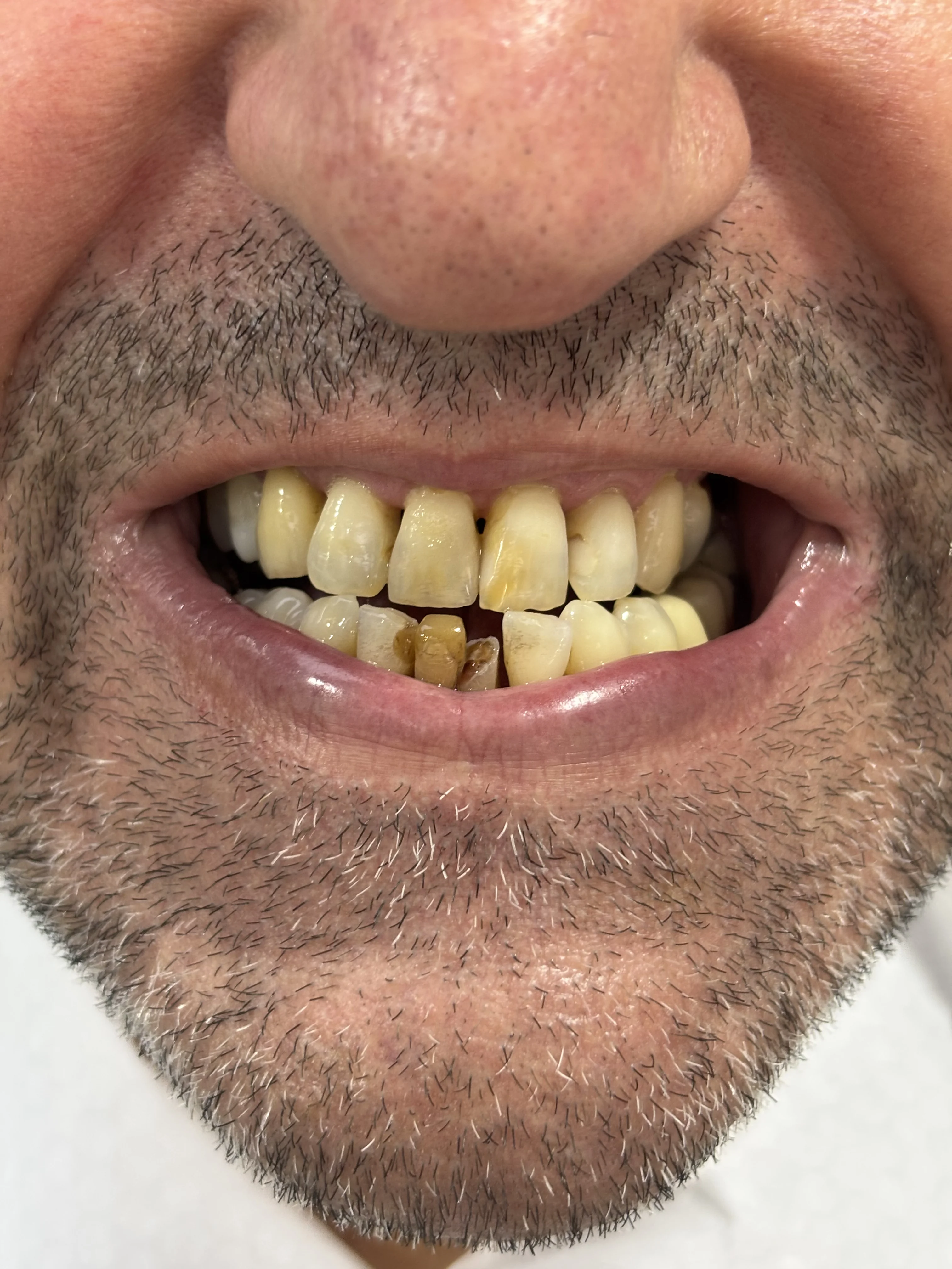 After: youthful, confident smile