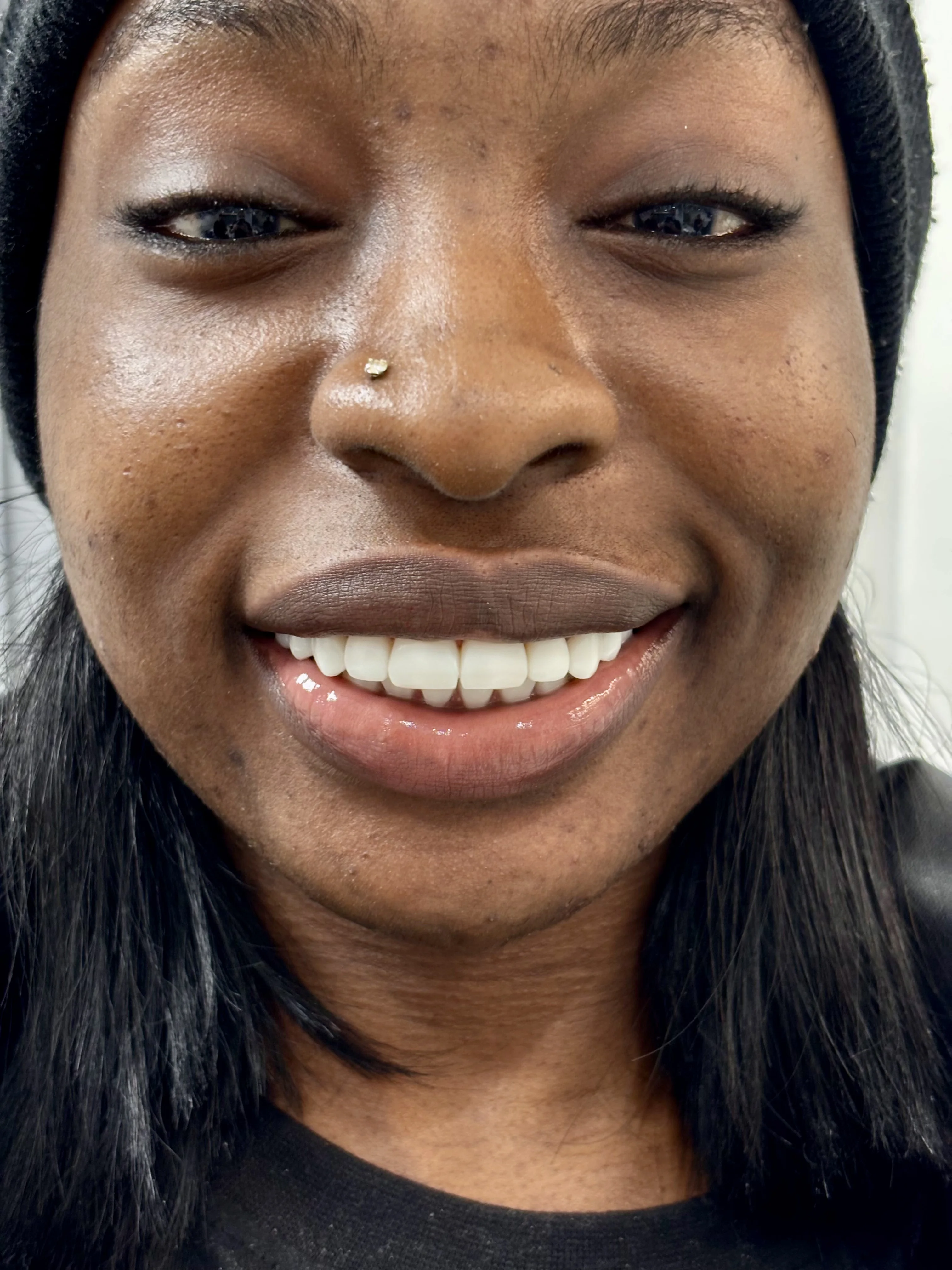 Before: conservative tooth preservation needed