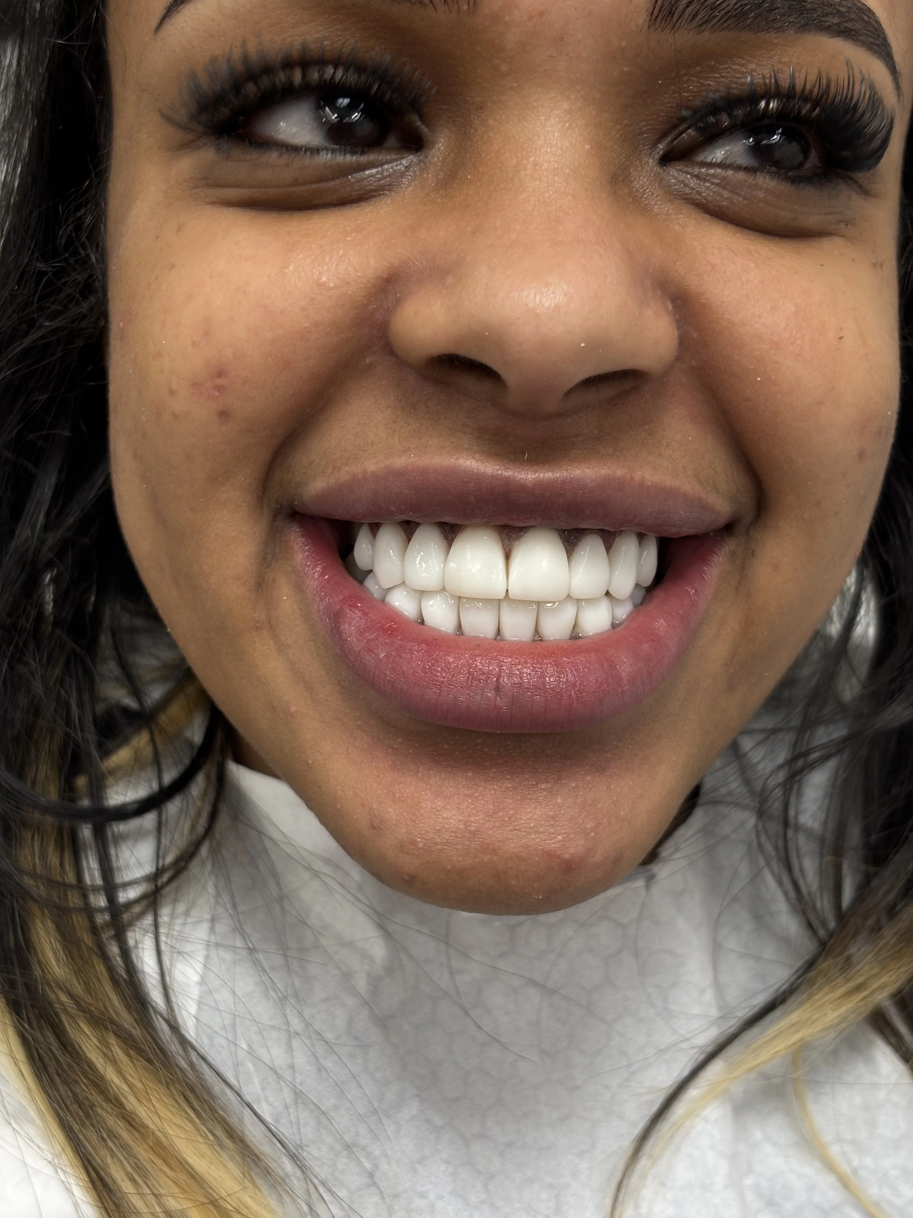 After: harmonious tooth proportions