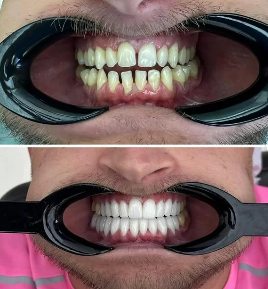 All-on-4 vs All-on-6: Which Full-Arch Option Is Better?