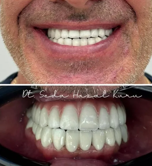 Zirconia Crown vs Porcelain-Fused-to-Metal