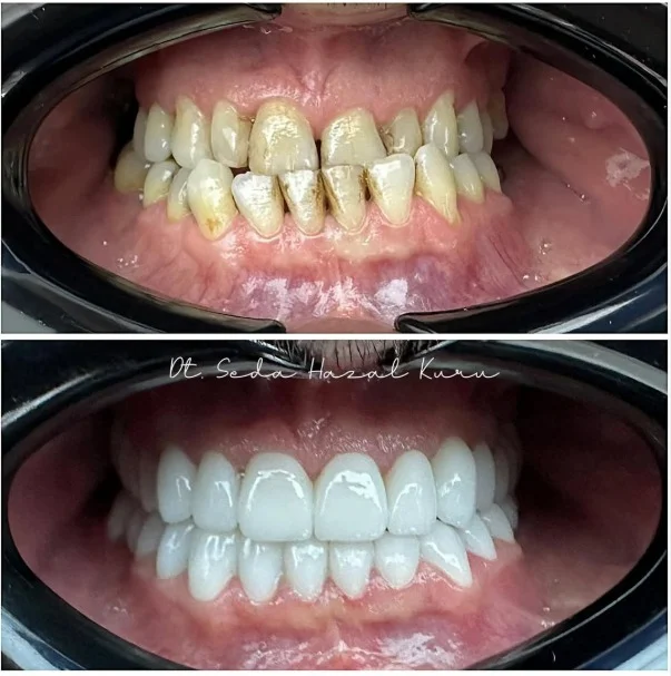 Is Dental Implant Treatment Safe for Smokers?
