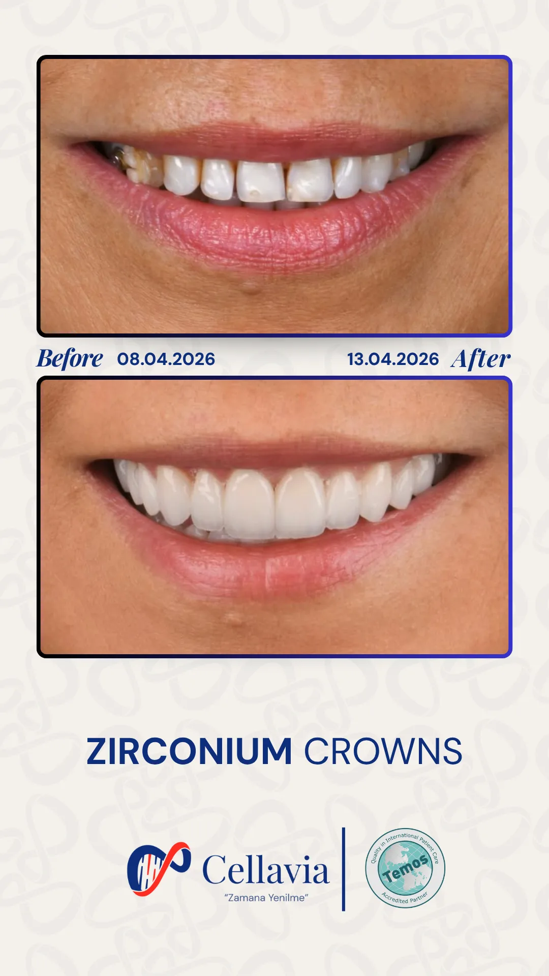 Zirconium Crowns before and after result at Cellavia Dental Clinic, Istanbul