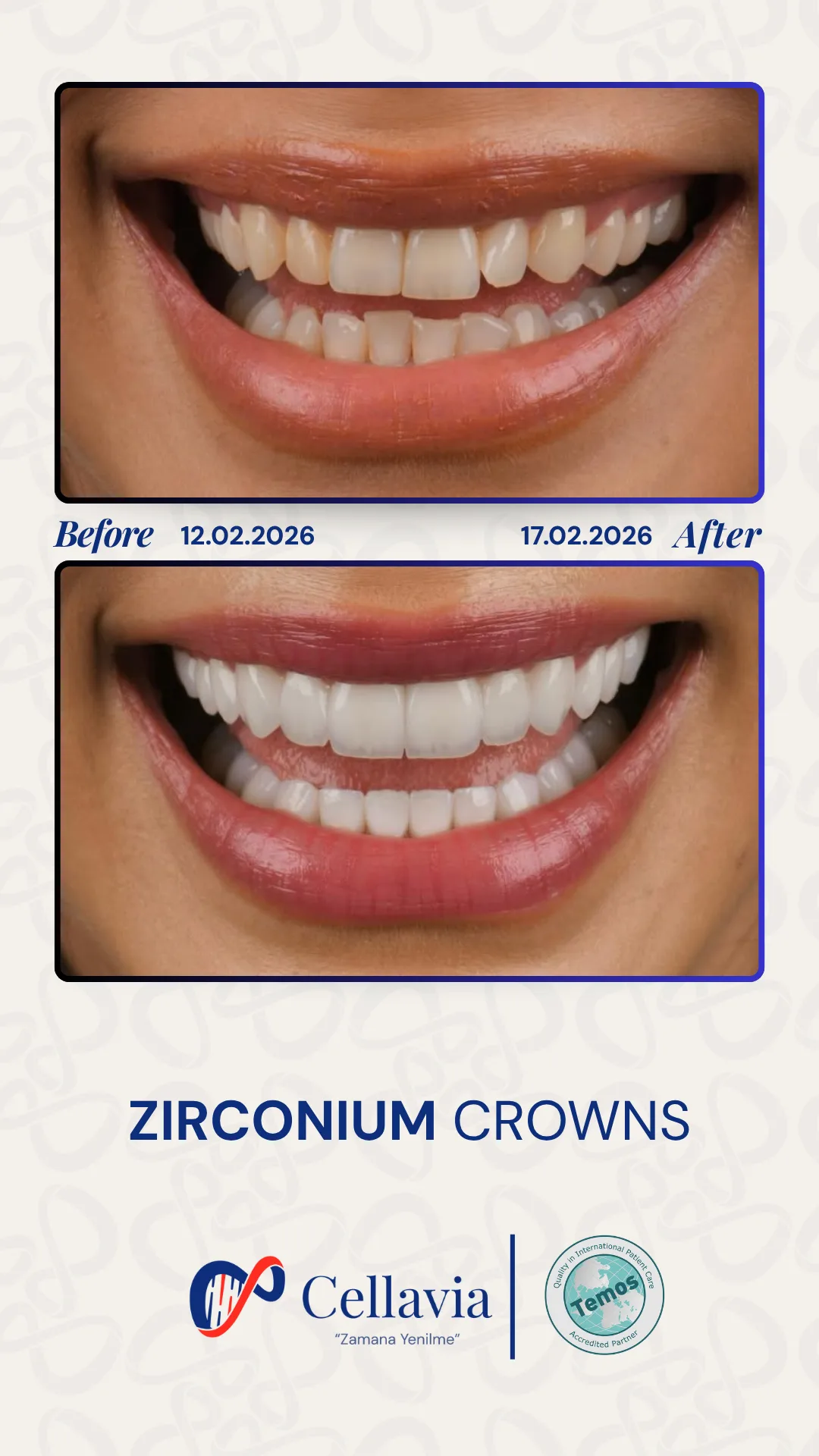 Zirconium Crowns before and after result at Cellavia Dental Clinic, Istanbul