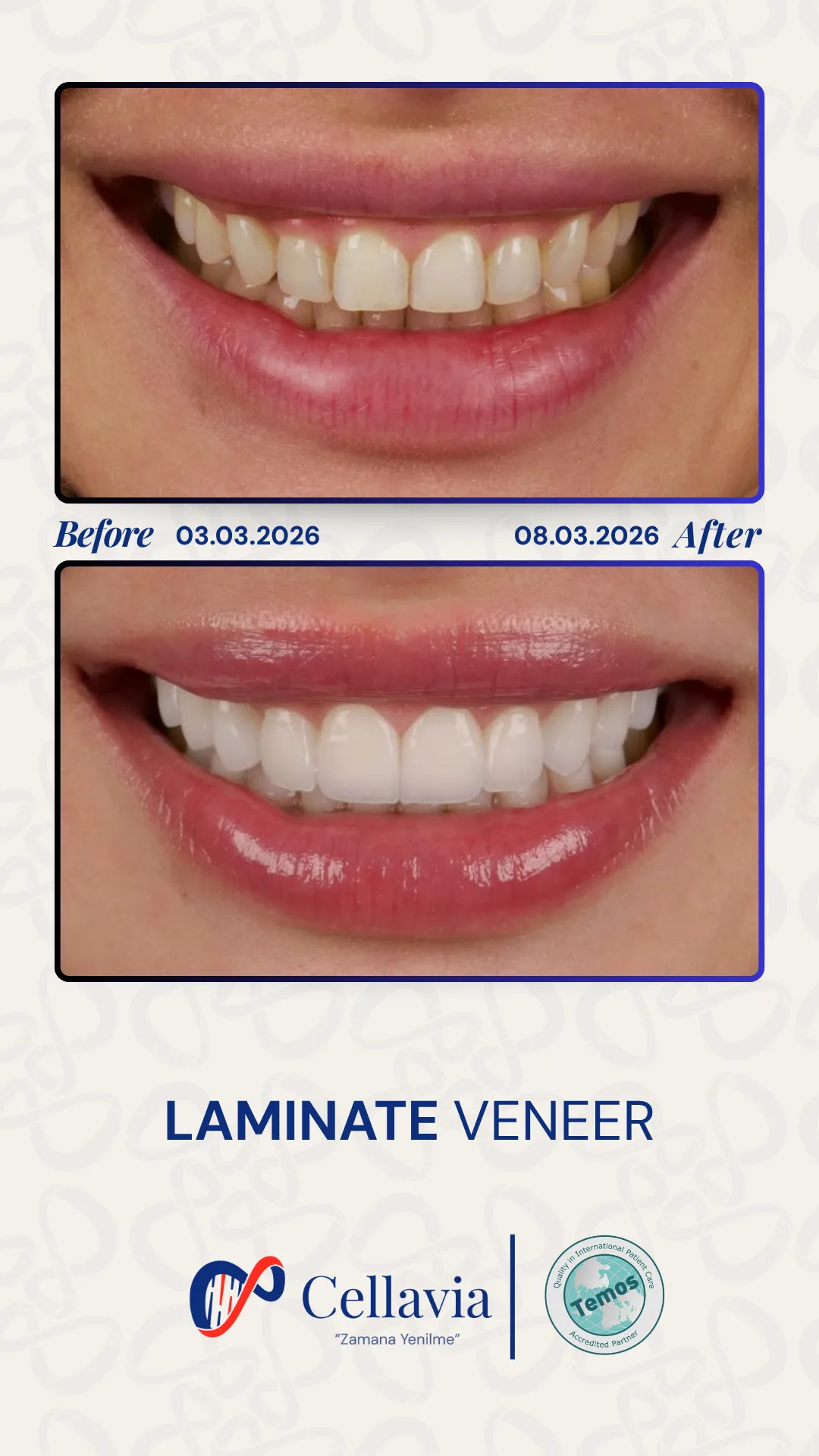 Laminate Veneer before and after result at Cellavia Dental Clinic, Istanbul