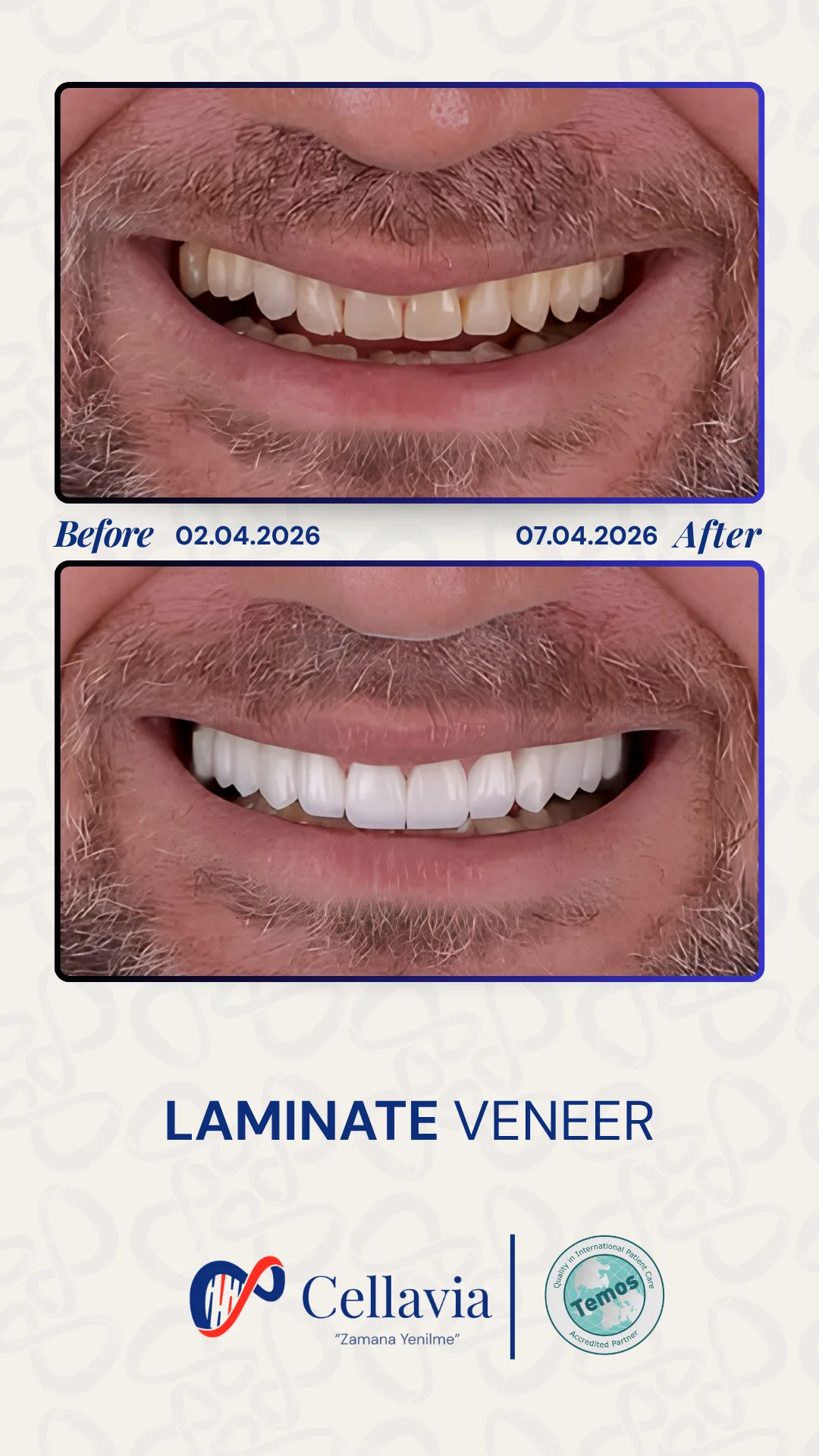 Laminate Veneer before and after result at Cellavia Dental Clinic, Istanbul