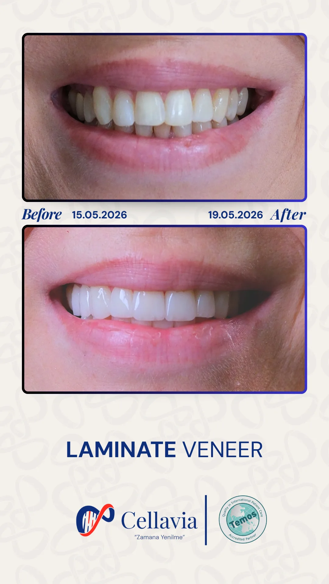 Laminate Veneer before and after result at Cellavia Dental Clinic, Istanbul