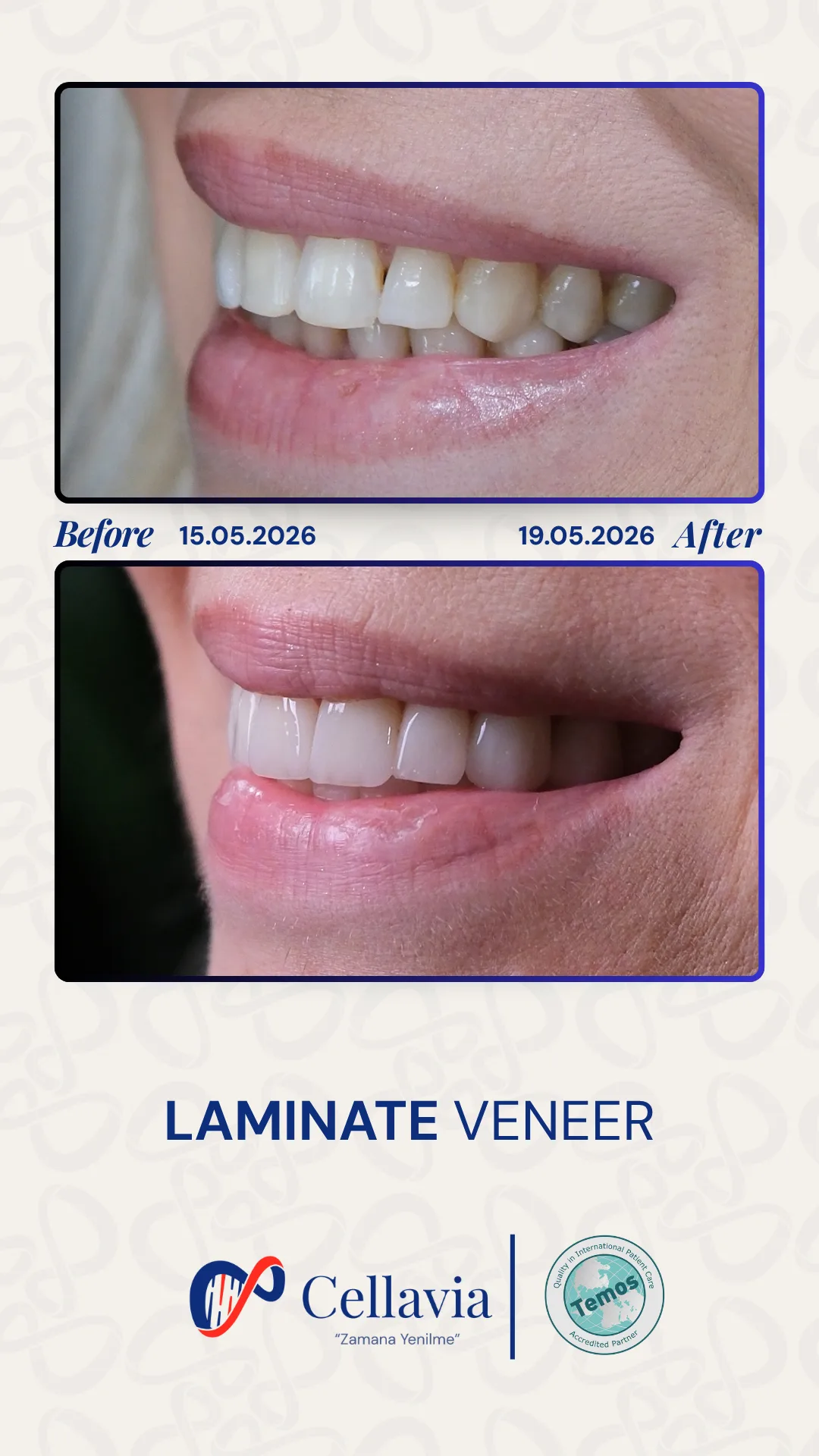 Laminate Veneer before and after result at Cellavia Dental Clinic, Istanbul