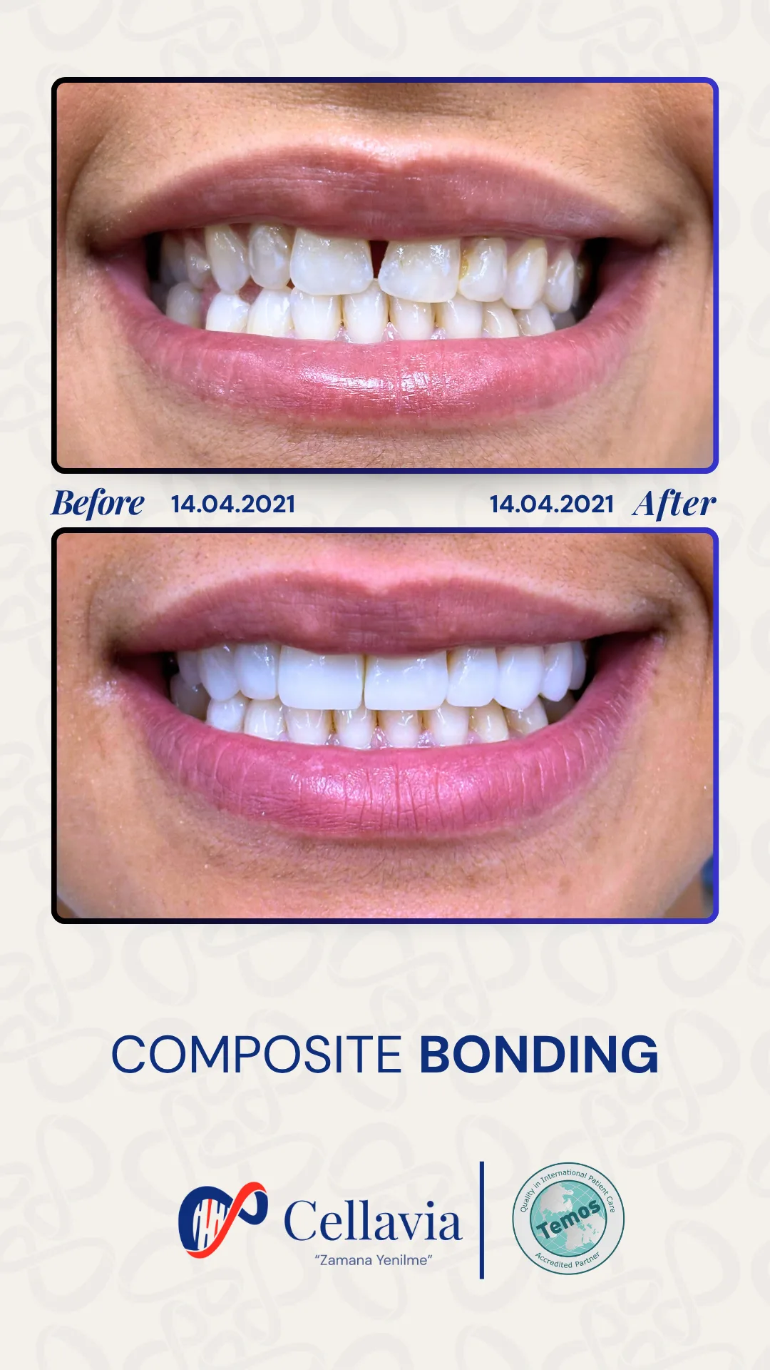 Composite Bonding before and after result at Cellavia Dental Clinic, Istanbul