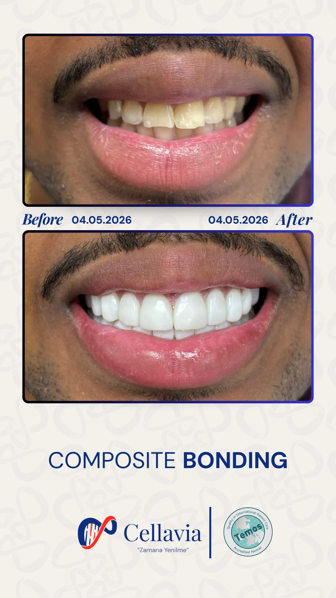 Composite Bonding before and after result at Cellavia Dental Clinic, Istanbul