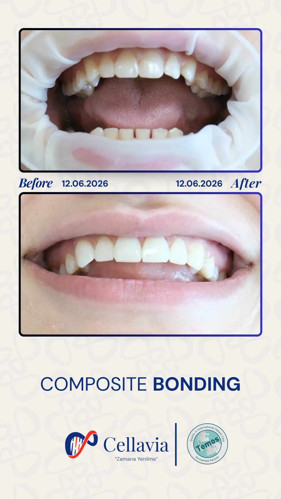 Composite Bonding before and after result at Cellavia Dental Clinic, Istanbul