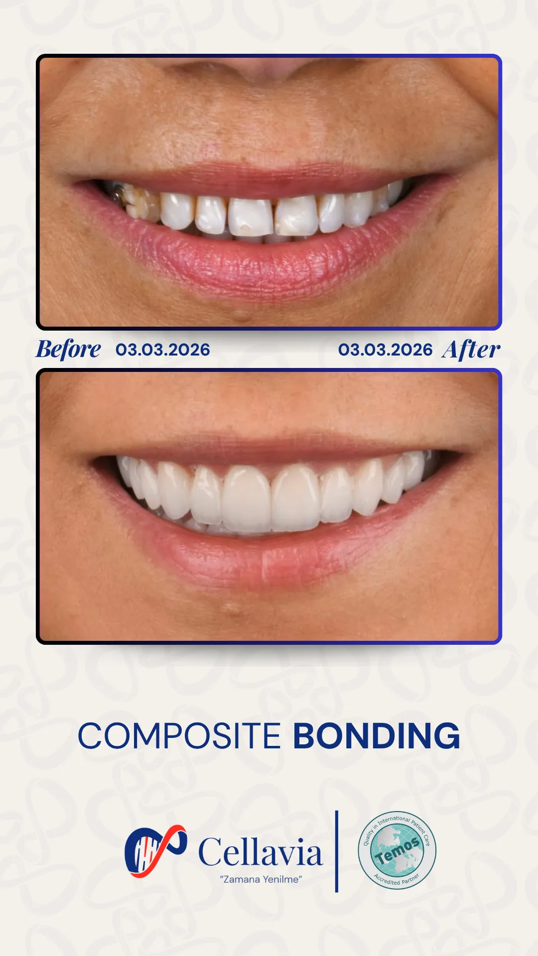 Composite Bonding before and after result at Cellavia Dental Clinic, Istanbul