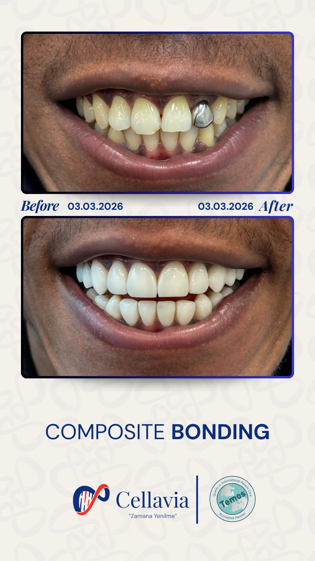 Composite Bonding before and after result at Cellavia Dental Clinic, Istanbul