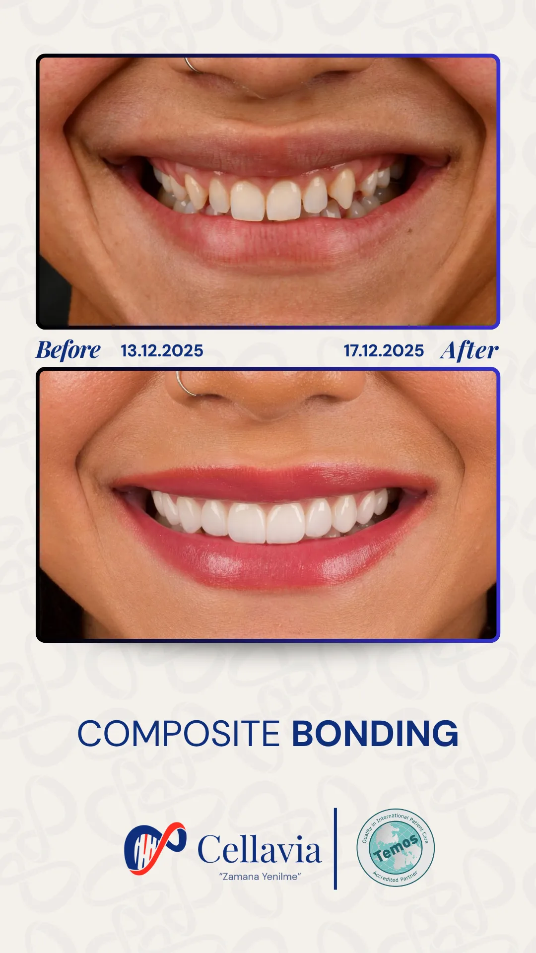 Composite Bonding before and after result at Cellavia Dental Clinic, Istanbul