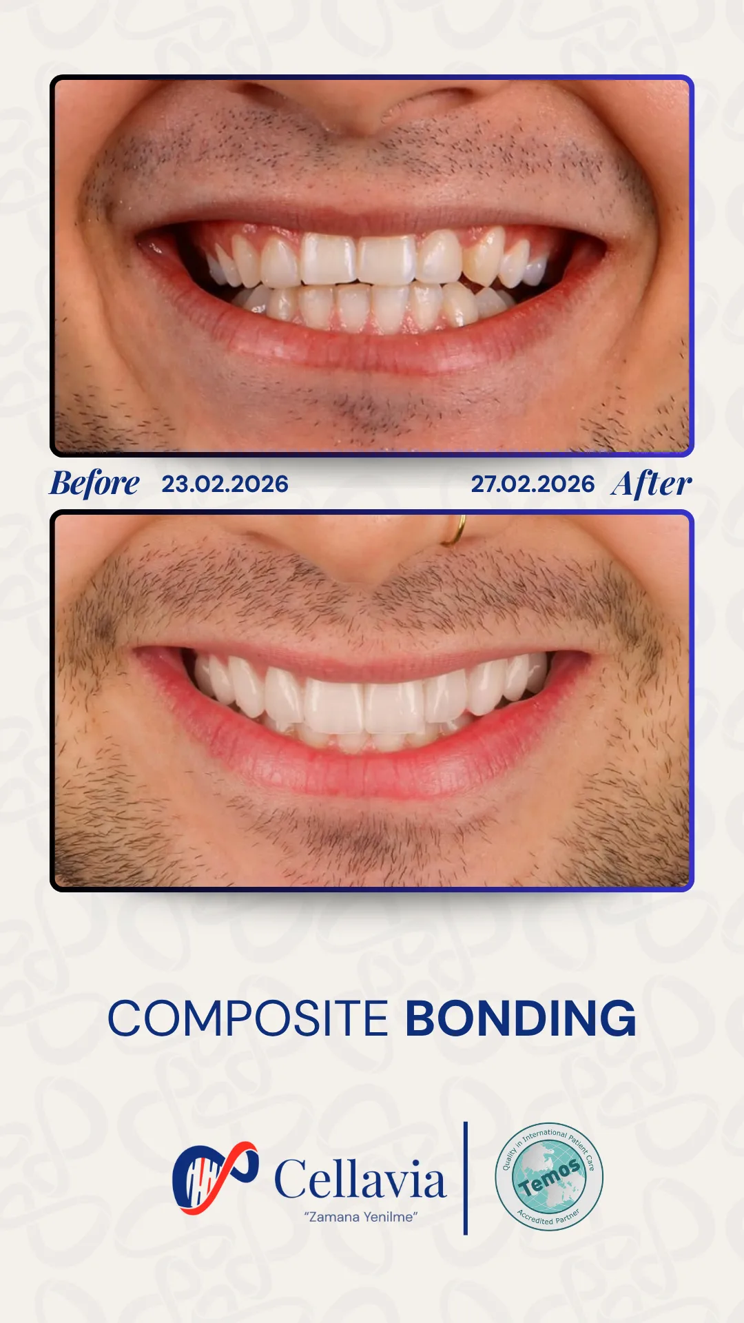 Composite Bonding before and after result at Cellavia Dental Clinic, Istanbul