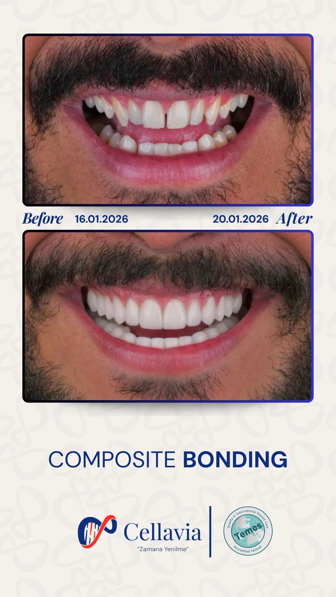Composite Bonding before and after result at Cellavia Dental Clinic, Istanbul