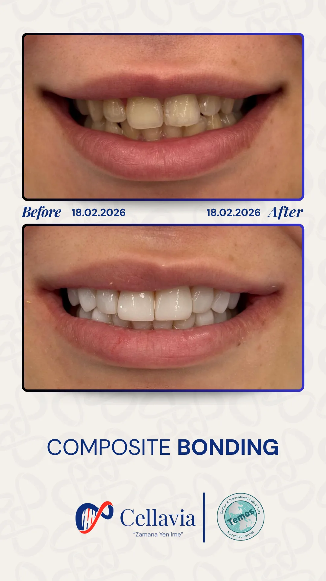 Composite Bonding before and after result at Cellavia Dental Clinic, Istanbul