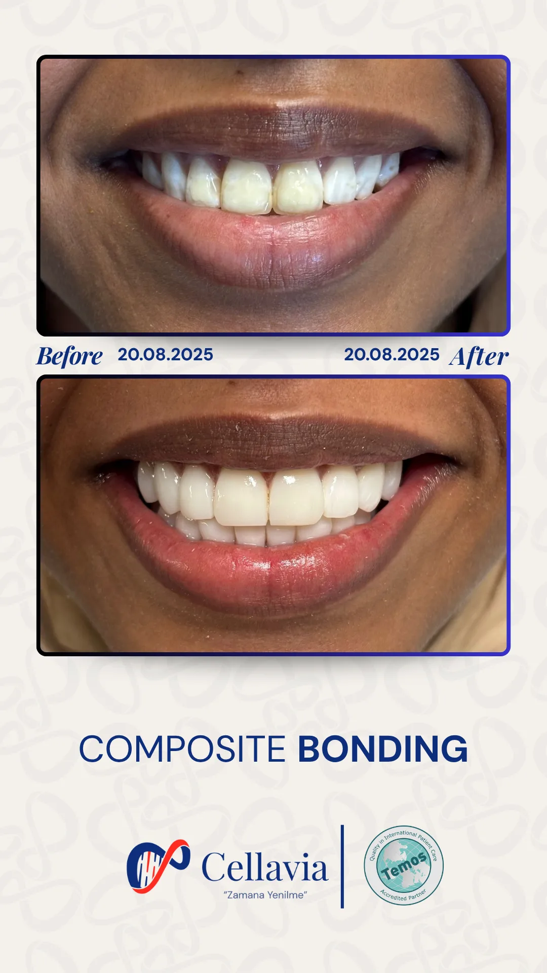 Composite Bonding before and after result at Cellavia Dental Clinic, Istanbul