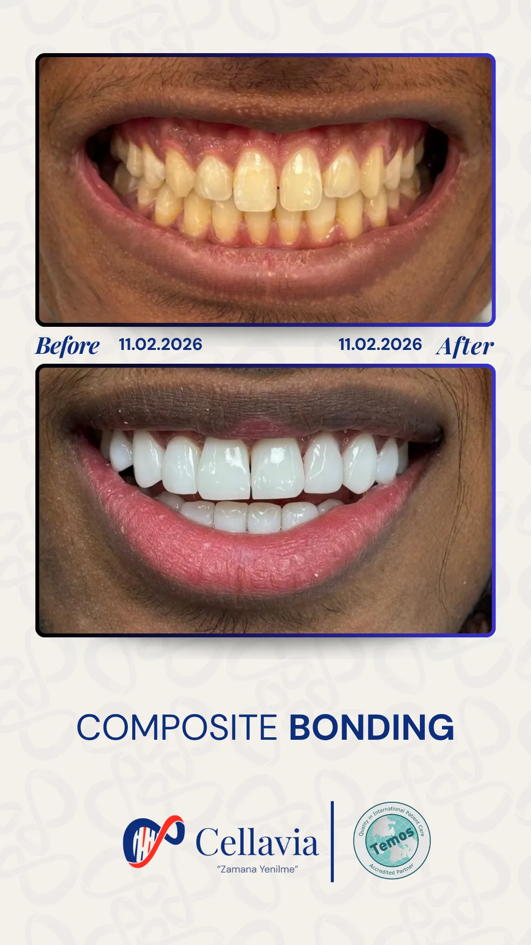 Composite Bonding before and after result at Cellavia Dental Clinic, Istanbul