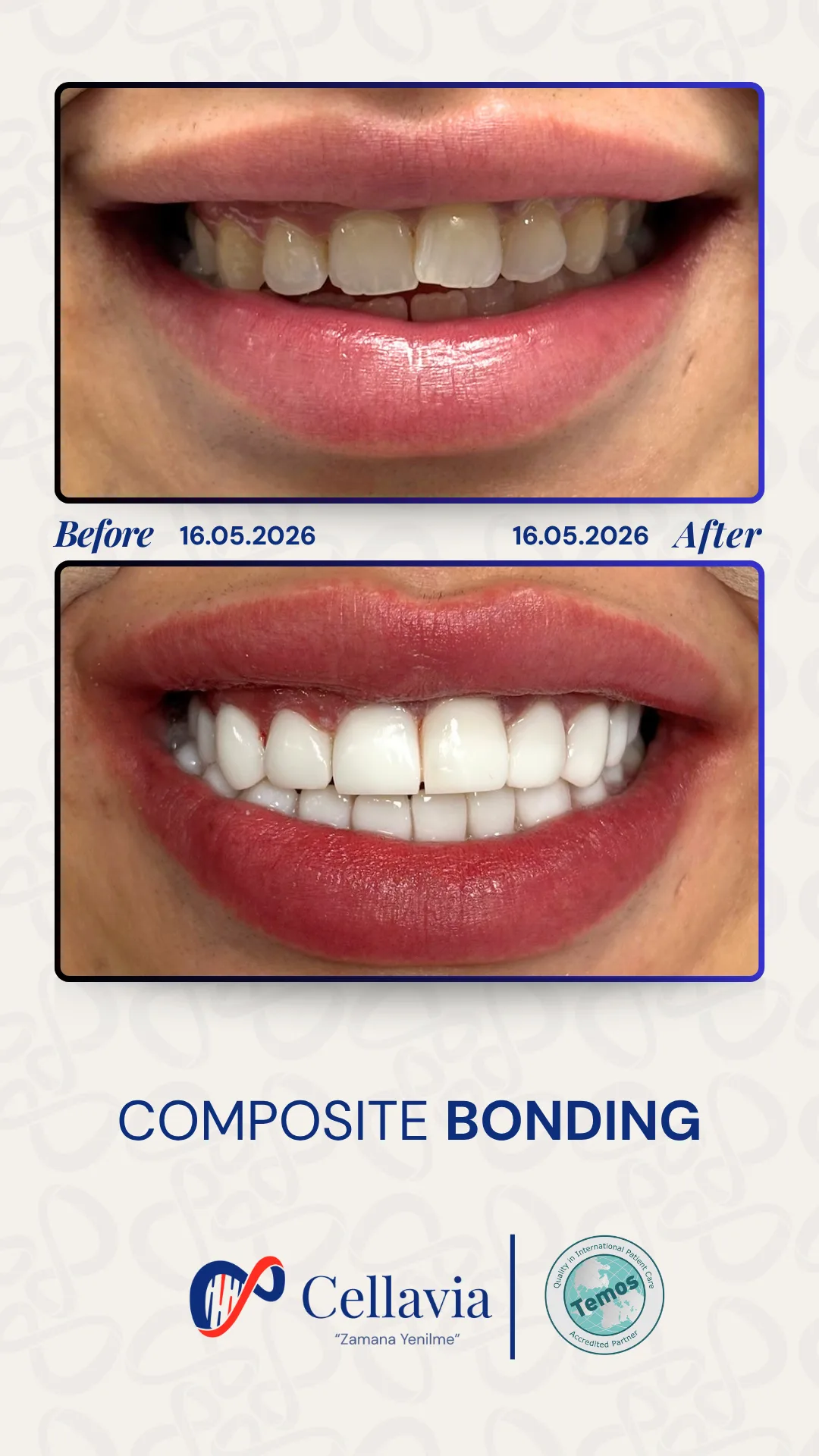 Composite Bonding before and after result at Cellavia Dental Clinic, Istanbul