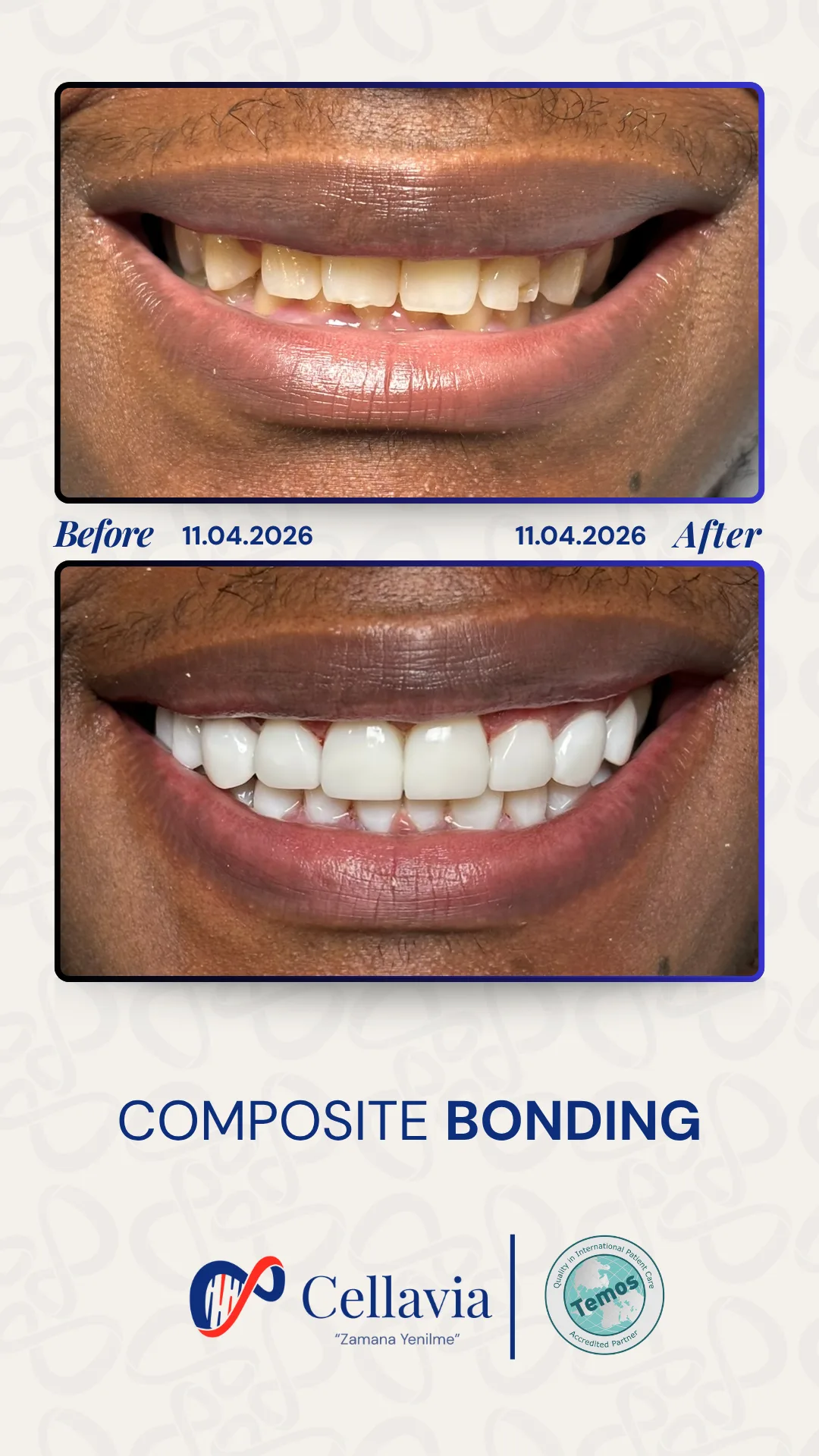 Composite Bonding before and after result at Cellavia Dental Clinic, Istanbul