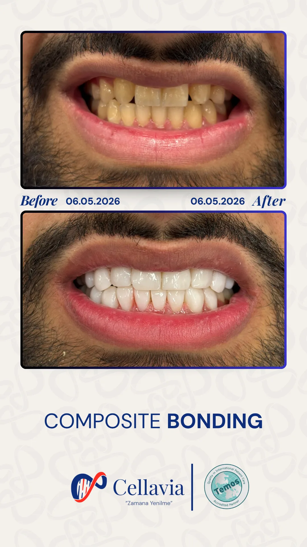 Composite Bonding before and after result at Cellavia Dental Clinic, Istanbul