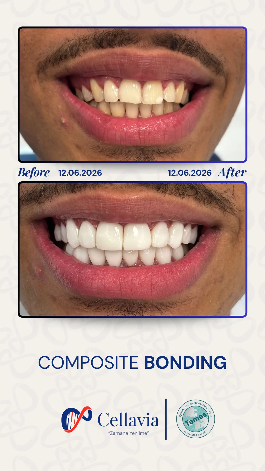 Composite Bonding before and after result at Cellavia Dental Clinic, Istanbul