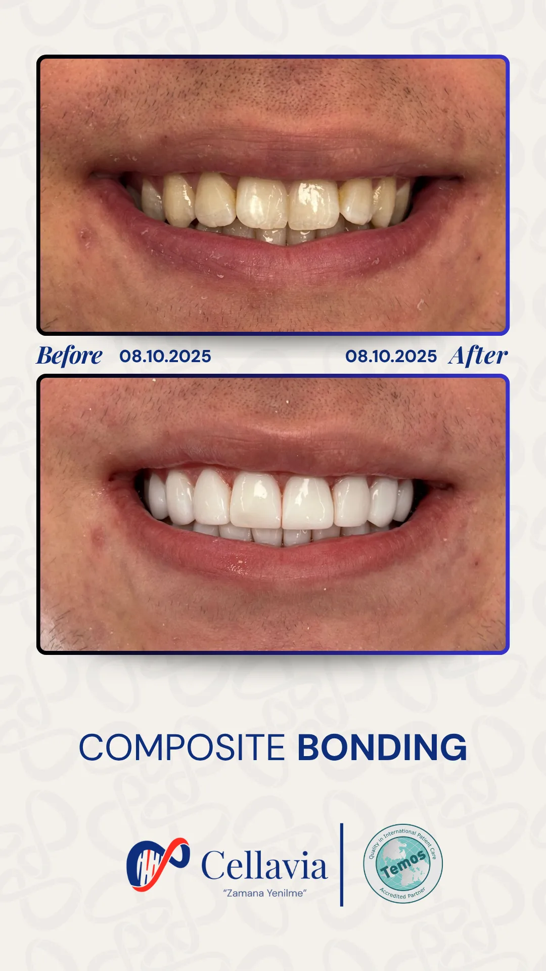 Composite Bonding before and after result at Cellavia Dental Clinic, Istanbul