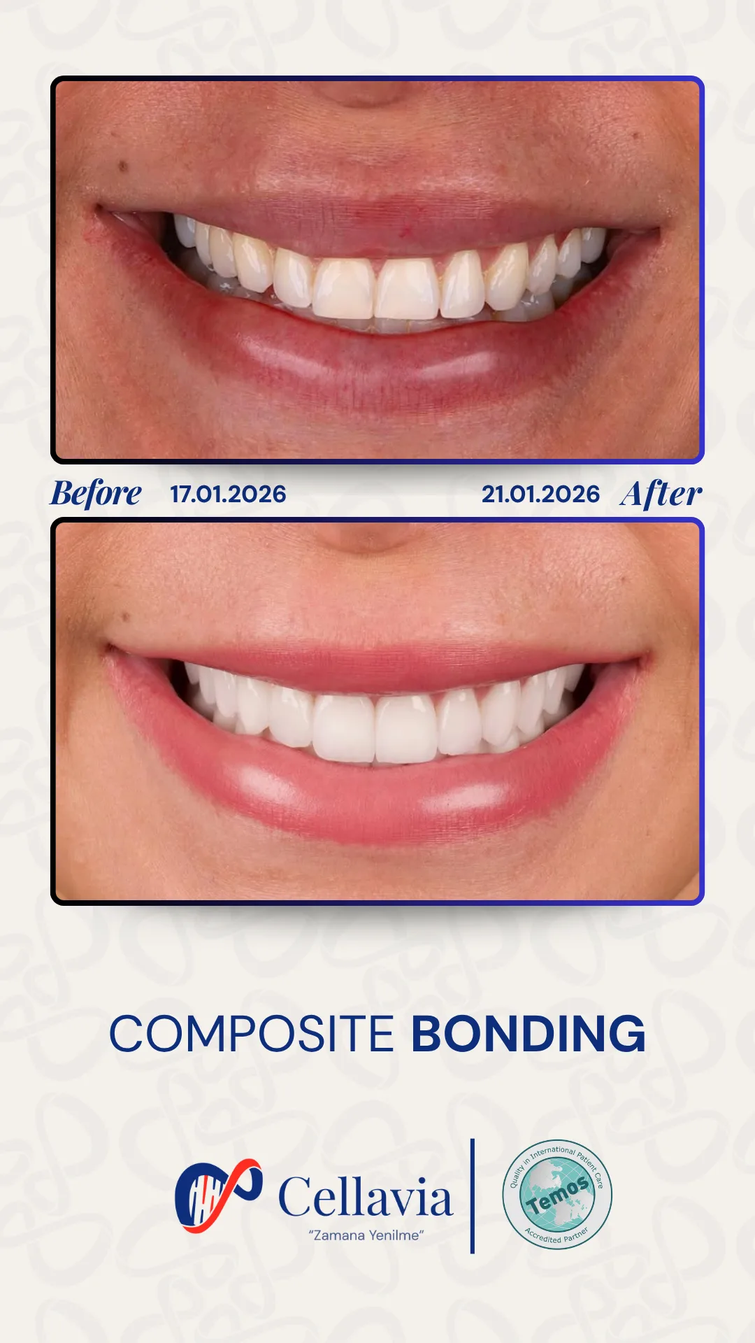Composite Bonding before and after result at Cellavia Dental Clinic, Istanbul