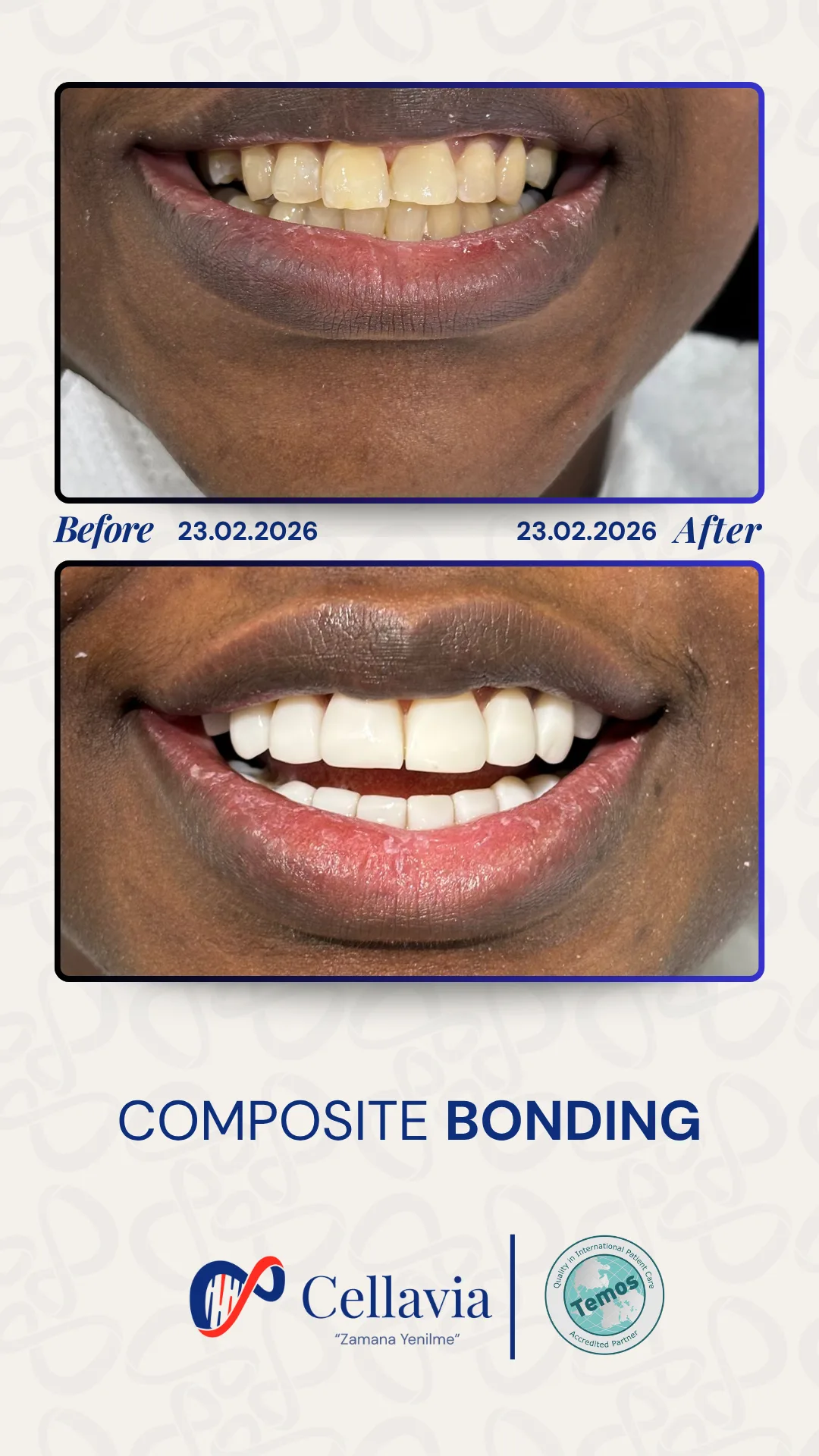 Composite Bonding before and after result at Cellavia Dental Clinic, Istanbul