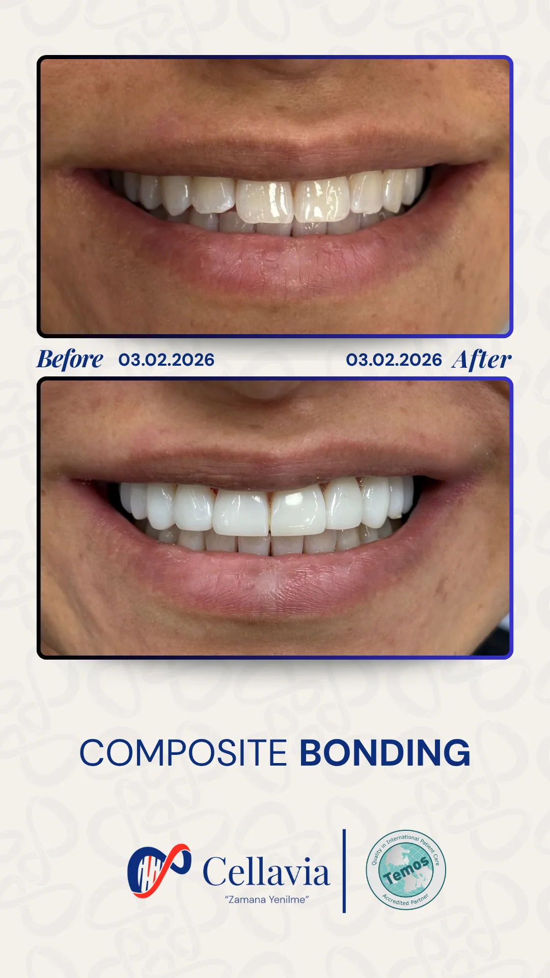 Composite Bonding before and after result at Cellavia Dental Clinic, Istanbul