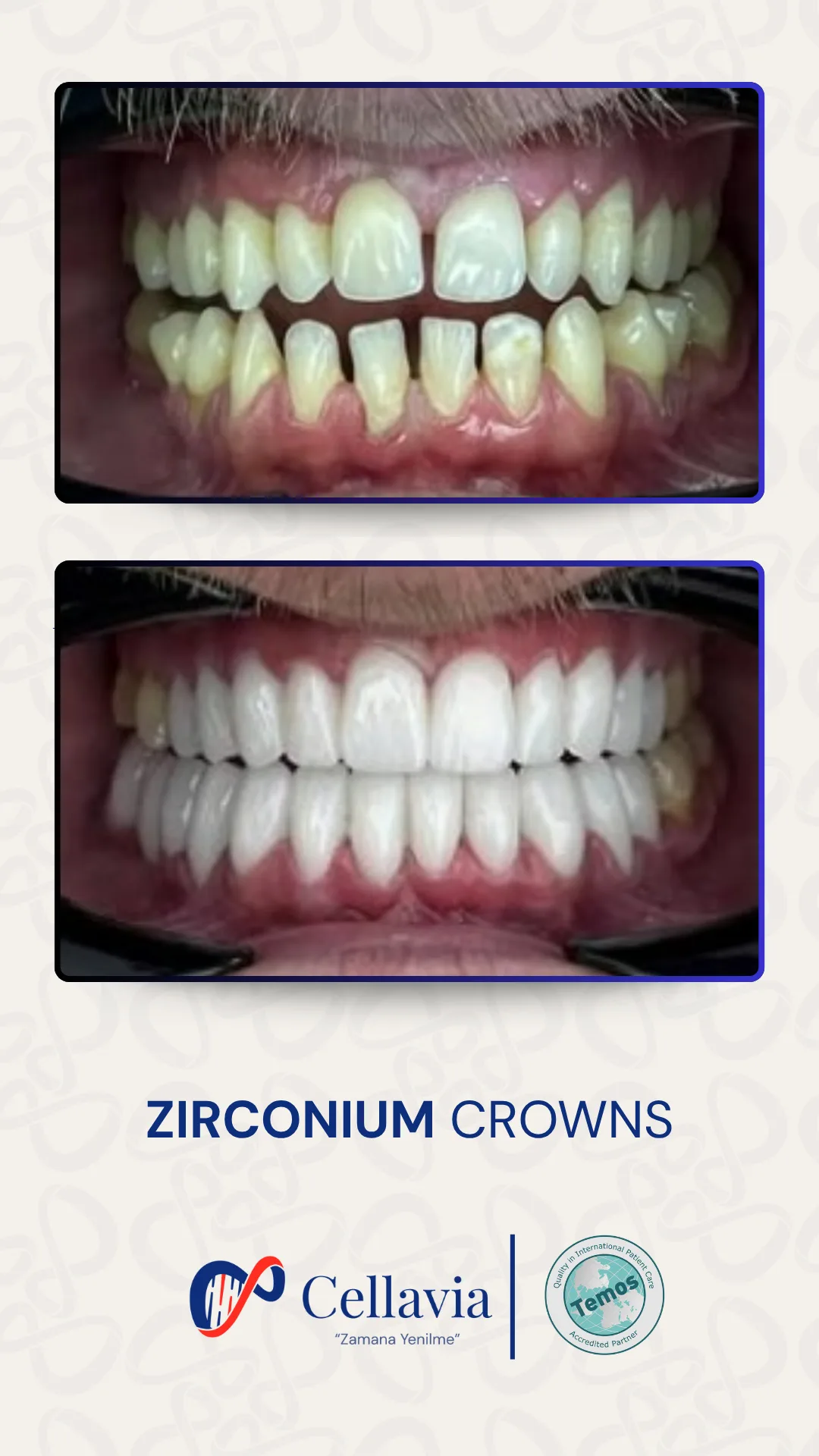 Zirconium Crowns before and after result at Cellavia Dental Clinic, Istanbul
