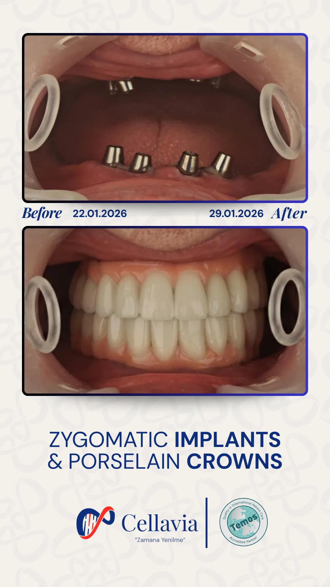 Zygomatic Implants & Porcelain Crowns before and after result at Cellavia Dental Clinic, Istanbul