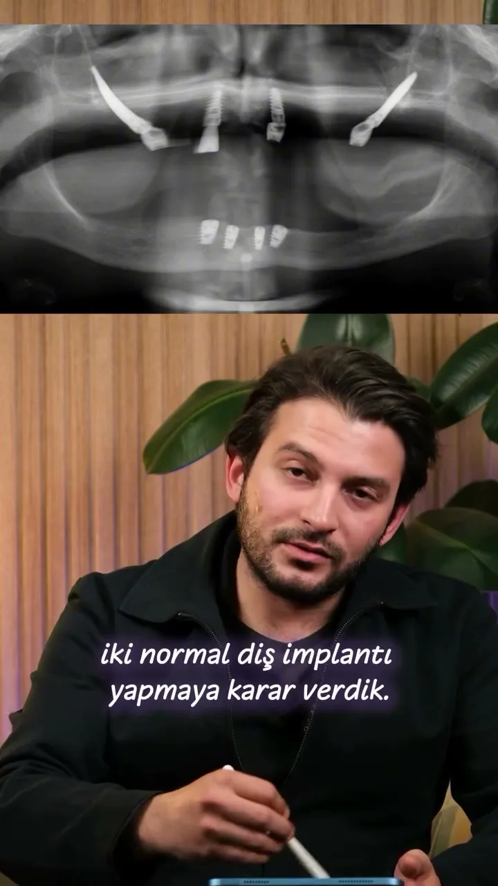 Zygomatic Implants at 79: Full-Mouth Restoration Case
